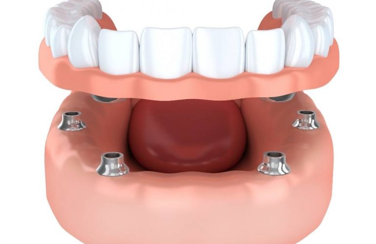 All-on-4™ rögzített fogsor Érd Oralcentrum Fogászati és Szájsebészeti Klinikaf
